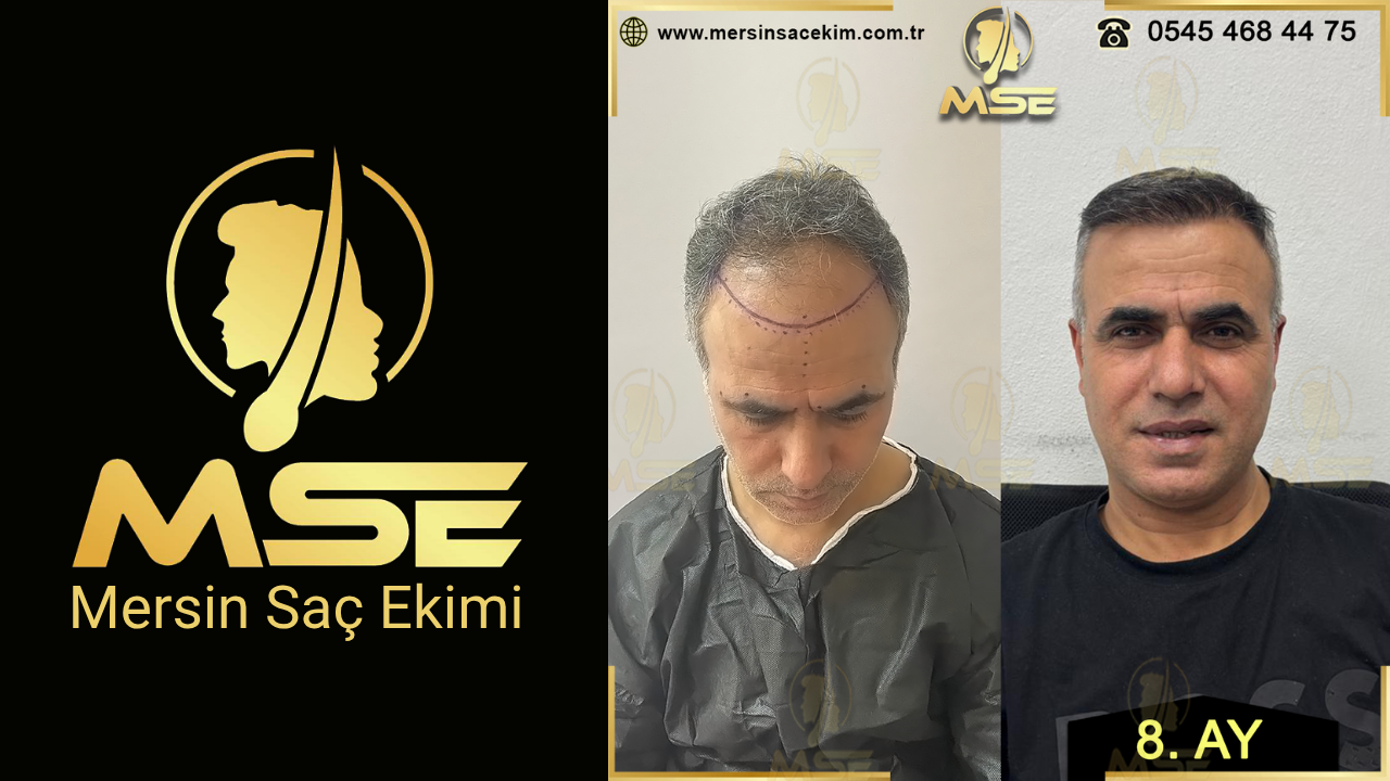 MERSİN SAÇ EKİMİ